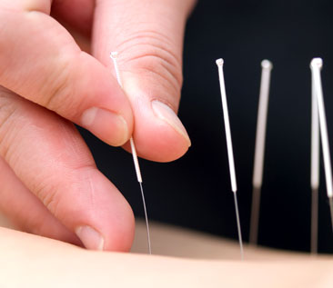 Quinte Chiropractic & Sports Injury Clinic - Acupuncture 