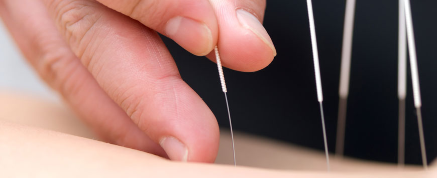 Quinte Chiropractic & Sports Injury Clinic - Acupuncture